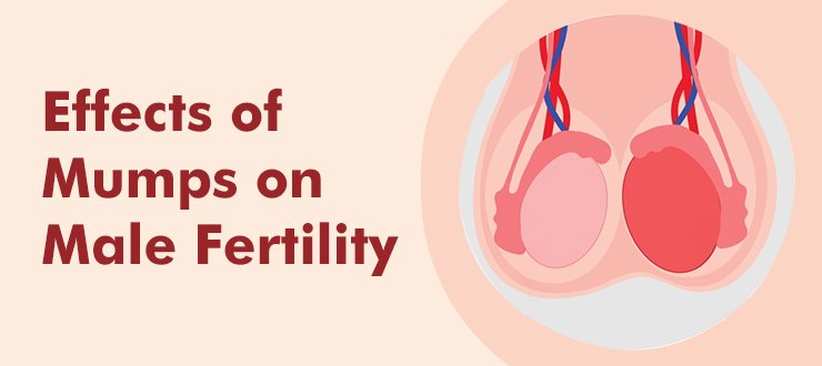 Effects of Mumps on Male Fertility