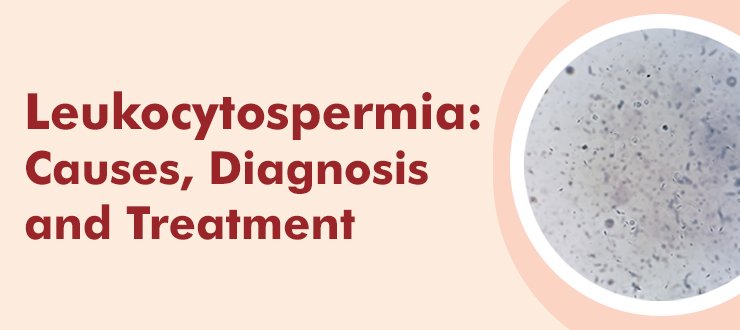 Leukocytospermia: Causes, Diagnosis, and Treatment